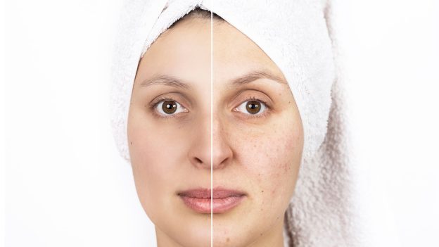 How does Biotin help to treat acne?